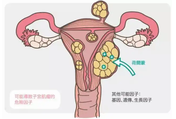 子宫肌瘤对月经的影响可不小，有这几个症状的注意了