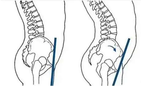 有哪些原因会造成骨盆前倾？骨盆前倾要怎么治疗？