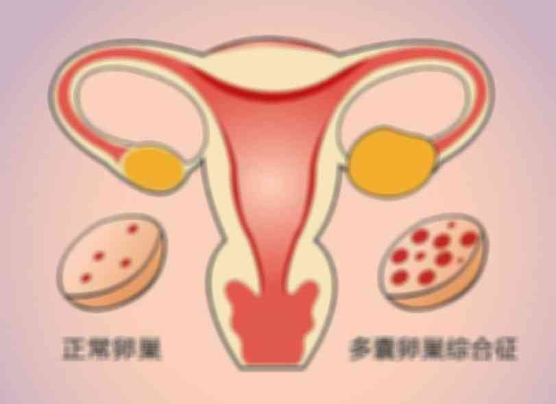 多囊卵巢综合征想怀孕？这几种方法很有效！