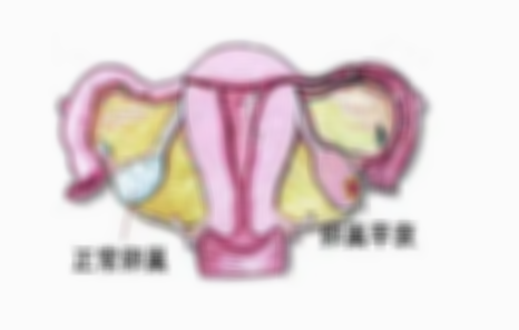 什么原因会导致卵巢早衰？教你几招轻松预防卵巢早衰