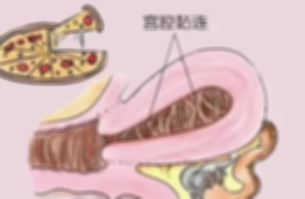 想知道宫腔粘连后会不会出现分泌物，还得看粘连程度