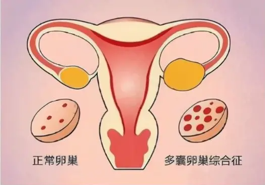 区分多囊严重程度的方法，如何确定多囊卵巢综合症是否严重？