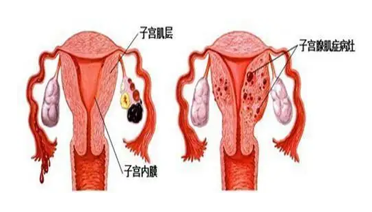 详述腺肌症移植后着床的5种症状