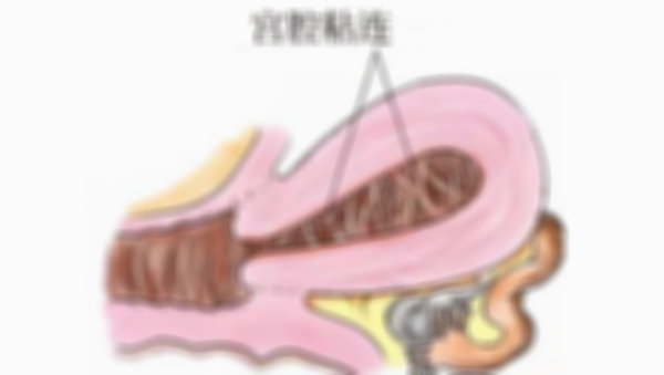 女性宫腔粘连手术前后的注意事项，帮助你更好地恢复