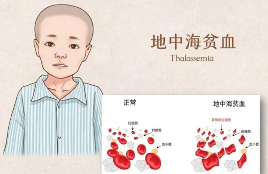 生育指南：患有地中海贫血的夫妻备孕注意事项都有哪些呢？