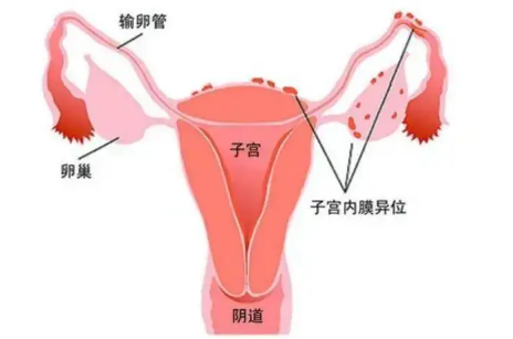 导致女性患有子宫腺肌症的原因你知道吗？