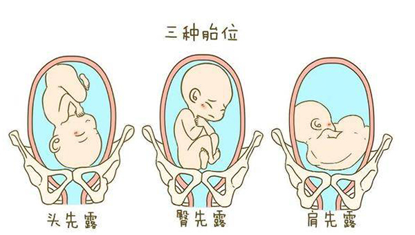 大家常说的胎儿臀位是什么意思？看完你就懂了