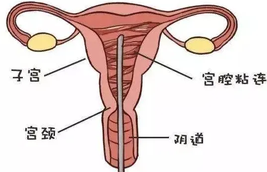 宫腔粘连怀孕之后会导致胎儿畸形吗？