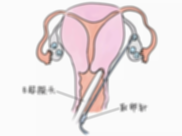 取卵手术：了解费用以及相关风险