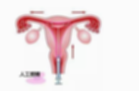 宫内人工授精是试管婴儿吗,宫内人工授精怎么做的
