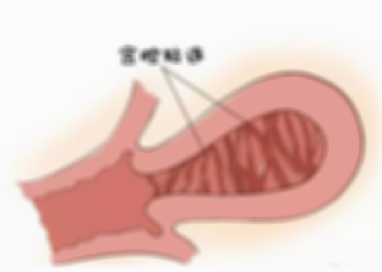 子宫粘连的危害有哪些,子宫沾黏严重是什么原因