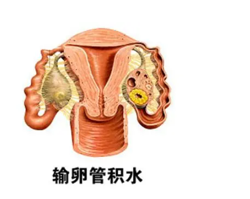 输卵管积水6厘米是否严重,输卵管积水怎样才能消除积水