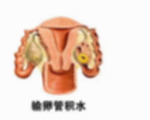 输卵管积水6厘米是否严重,输卵管积水怎样才能消除积水