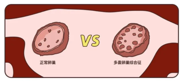 轻微多囊，自然怀孕的机会还是可以争取的