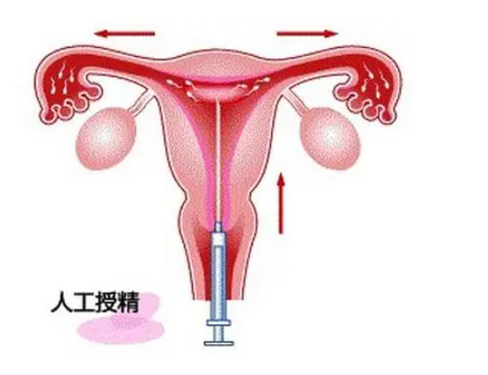 人工授精成功率有多少,人工授精的孩子好不好