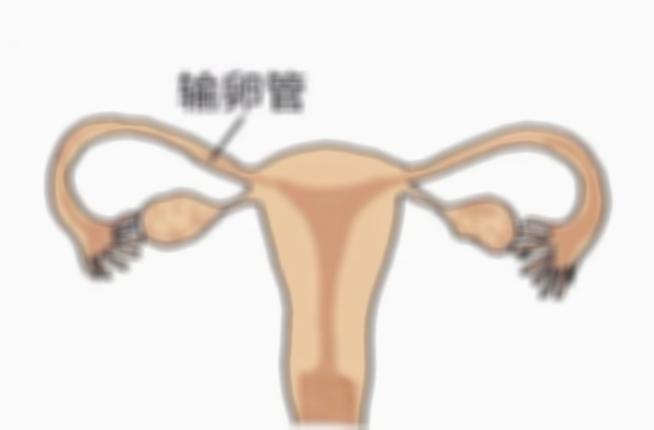 输卵管堵塞手术没有你想象中那么痛苦，无痛让你轻松度过
