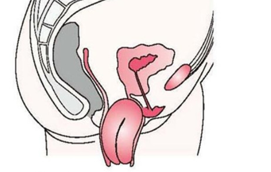 子宫颈脱出如何预防,怎么防止子宫脱落下来