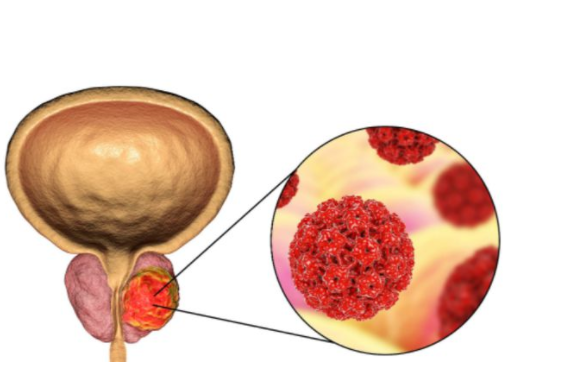 晚期前列腺癌的症状有哪些,前列腺癌的晚期对身体有什么损害