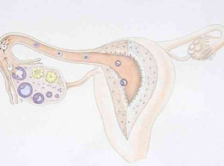 多囊性卵巢综合症患者做试管,这几点要必须做一下了解