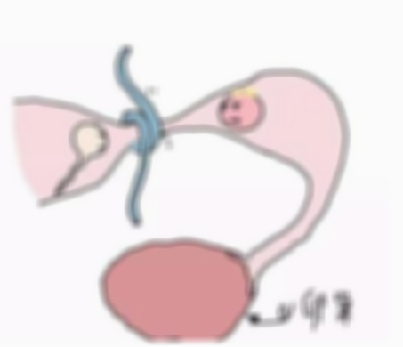输卵管黏连能做试管婴儿吗,输卵管黏连做试管婴儿能成功吗