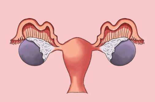 试管婴儿患卵巢癌的风险：试管婴儿和卵巢癌之间的关系