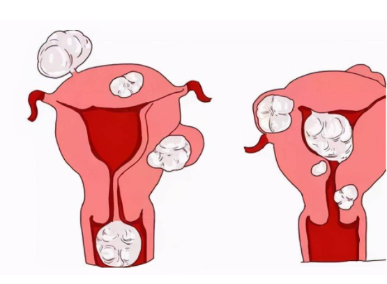 子宫肌壁结节可以怀孕吗 子宫肌壁结节需要注意什么