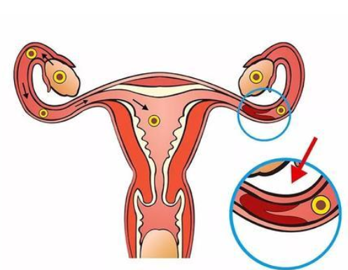月经量少会不会影响输卵管堵塞，做好预防措施很重要！