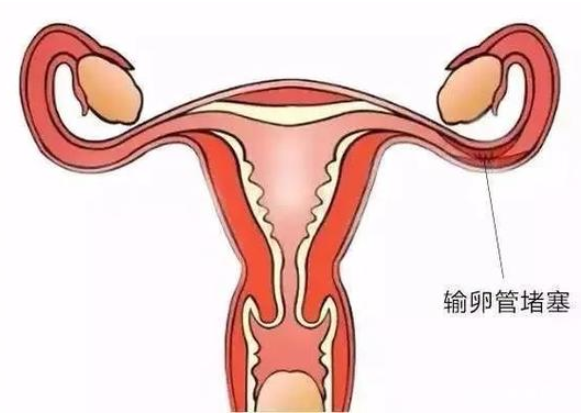 中医能否治疗输卵管堵塞？几个方法帮助疏通堵塞输卵管