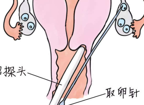 取卵的过程是怎样的？需要注意哪些事项？