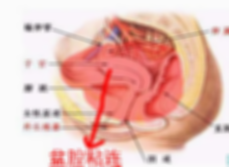 盆腔粘连做试管婴儿不再是障碍，重拾生命的希望