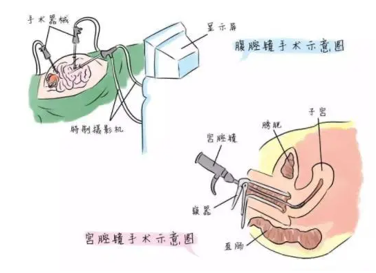 做完宫腔镜不吃消炎药直接做试管婴儿可以吗？