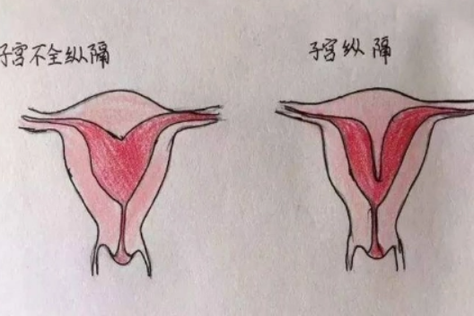 子宫纵膈做试管成功率怎么样？看完这篇你就懂了