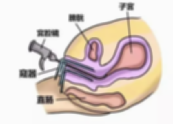 试管一定要做宫腔镜检查吗？试管人群宫腔镜检查必不可少
