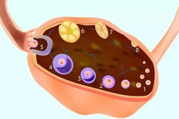 13个基础卵泡只留下2个，AMH低下，多囊卵巢逼近，别大意