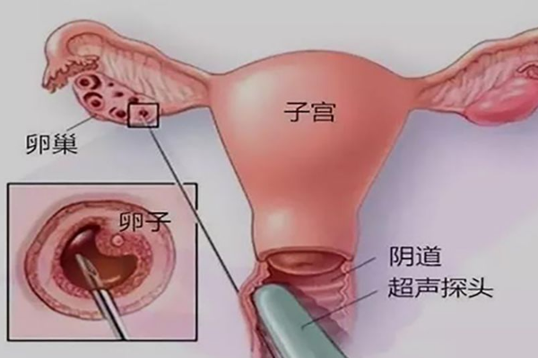 试管取卵和人流谁更痛？深入解析让你心里有数