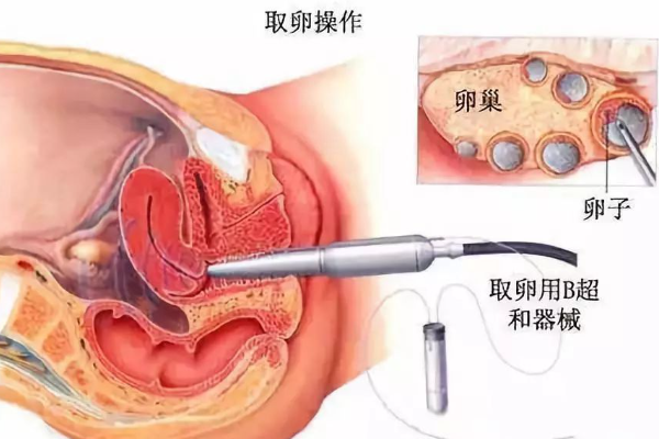 卵泡采集后第8天同房：看血液和疼痛信号保护健康先行！