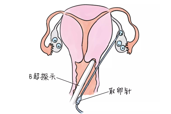 取卵个数增加女性健康暗藏风险！了解这4大危害保持警惕！