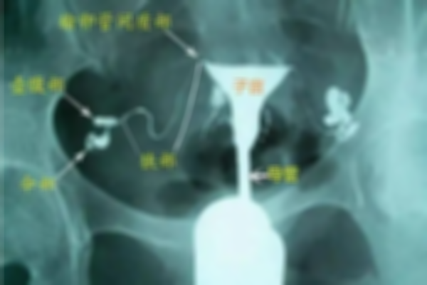 在乌鲁木齐寻找专业输卵管堵塞疏通的医院？还能提供造影复通方式！