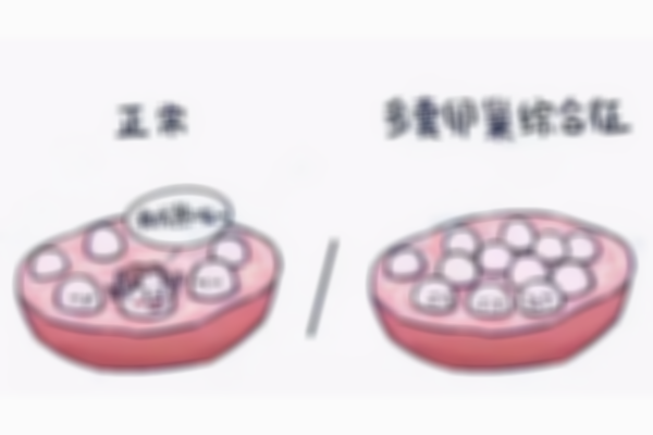 试管婴儿时多囊卵巢综合症患者需要注意哪些事项？内附身体调理