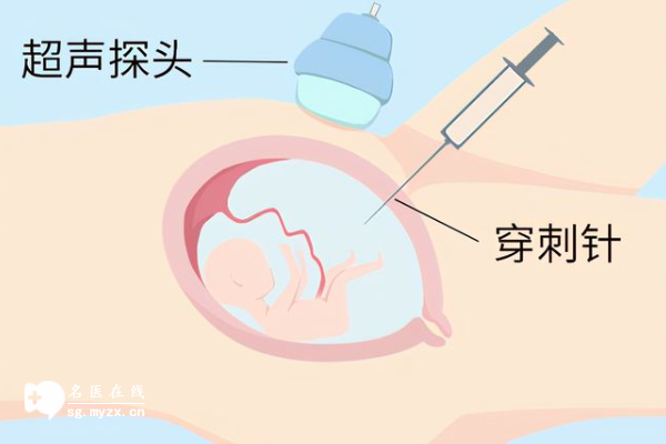 二代和三代试管婴儿建议羊穿的原因有哪些？附上检查畸形的重要性