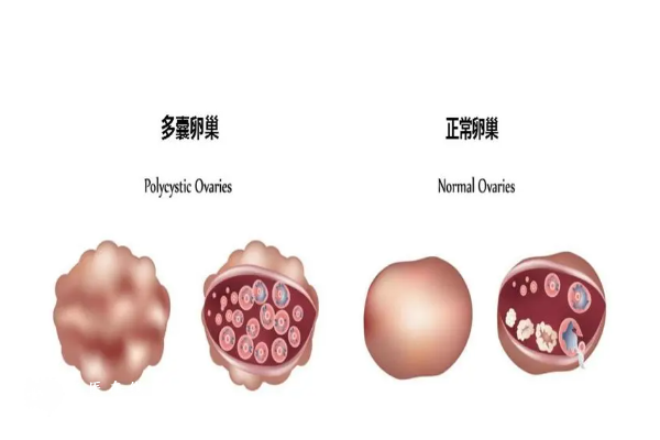 多囊卵巢试管婴儿的成功率是多少？附上成功率介绍和提高的方法