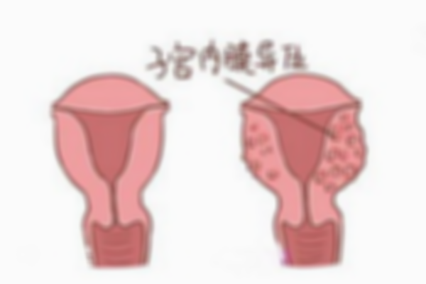 子宫内膜异位症能做试管婴儿吗？附上影响和注意事项