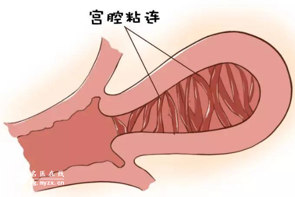 剖腹产后宫腔粘连的几率并不大，但也要做好这三项防护措施