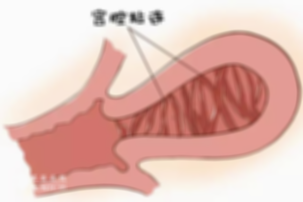 剖腹产后宫腔粘连的几率并不大，但也要做好这三项防护措施