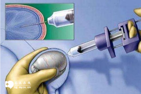 穿刺取精手术费用包含这些方面，附影响手术费用的四大因素