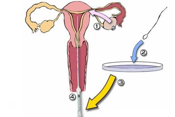 人工授精的成功率高不高？附提高人授成功率的方式