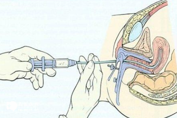 人工受孕费用在10万元以上，符合条件可进行医保报销