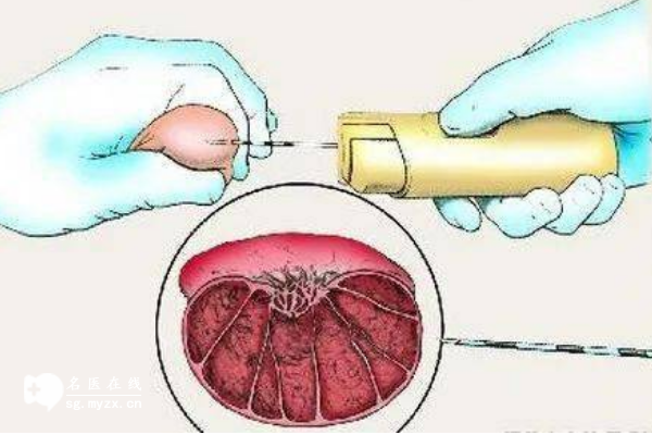 穿刺取精做试管并不会降低受孕率，也不会有流产风险