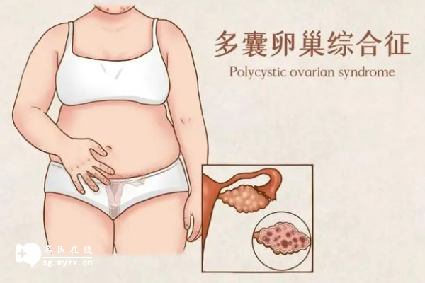 多囊患者不能吃鸭肉鸡肉？适量食用无影响