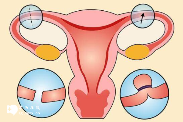 为什么有宫角粘连就不建议做试管？解析移植胚胎着床产生的负面影响